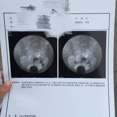 13年宫外孕做手术,切除了右侧输卵管,15年11月