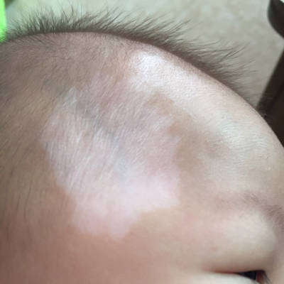 宝妈们有没有见过宝宝太阳穴位置有块白斑的?一出生就