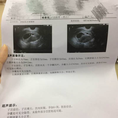 6周+BC有胎芽胎心，但孕囊处可见分隔带，未排除部分宫腔粘连的可能。请问很严重吗?很担心_育儿问答_宝宝树