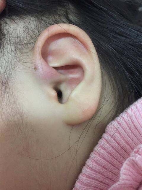 先天性耳前瘘管发炎