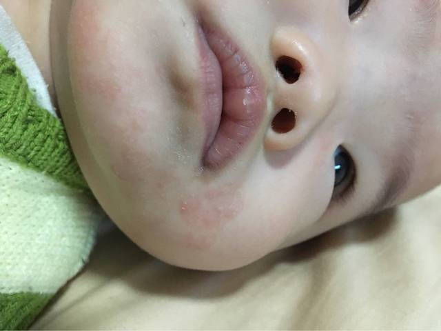 宝宝嘴巴边长红点点,有图,麻烦帮看看_宝宝七