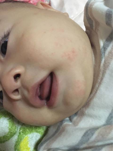 帮帮忙看一下宝宝脸上长什么,一点点的红点_帮