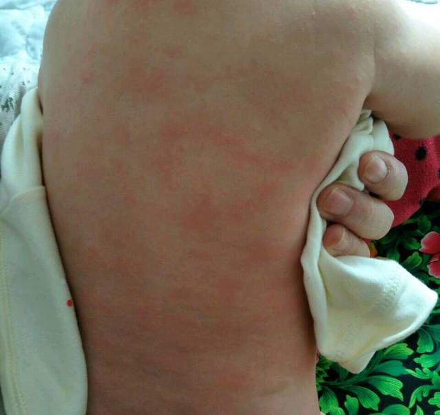 孩子4个月全身起红点,不发烧。什么原因?_孩子