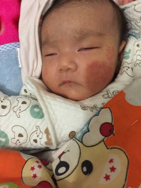 宝宝起湿疹了怎么办?_宝宝小脸通红滴,心疼死