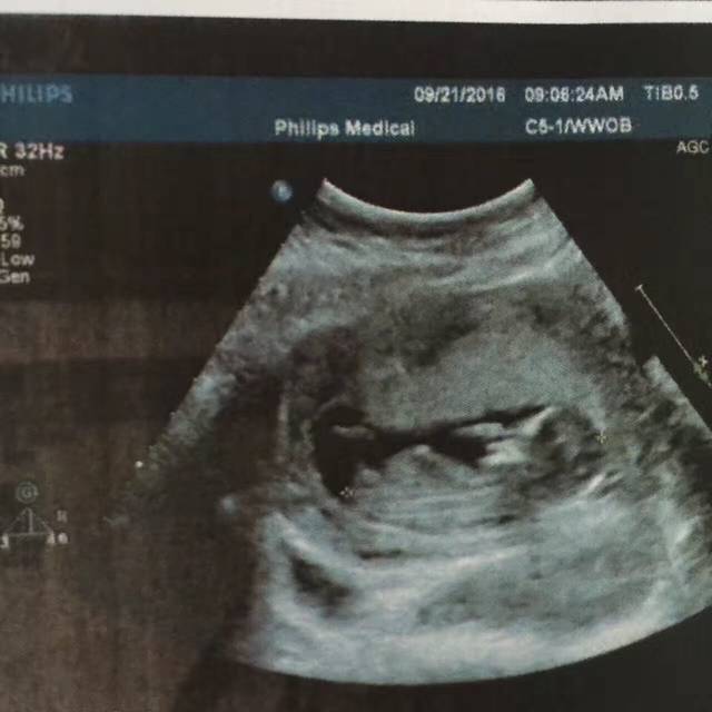 是不是男宝?_这是做NT的B超单,能看出是男宝