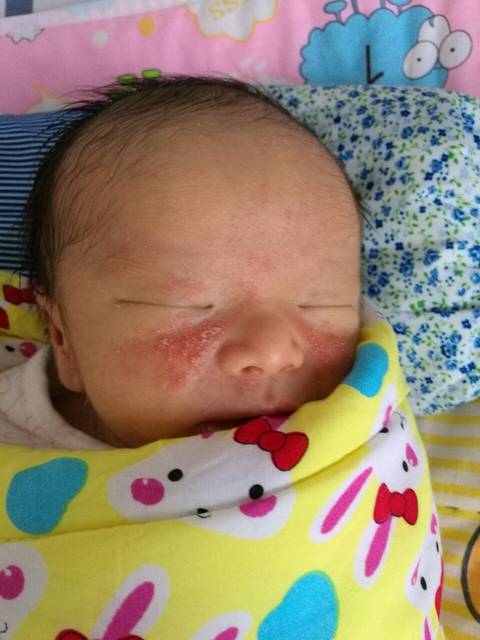 脸上起了小疹子_宝宝出生第九天,脸上起了些小