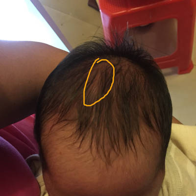 宝宝出生14天 ,今天下午洗头时头顶都没有异常