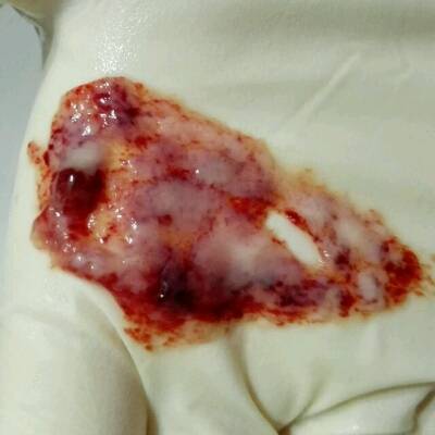 怀孕第47天时生化了,当天就排出类似孕囊的肉