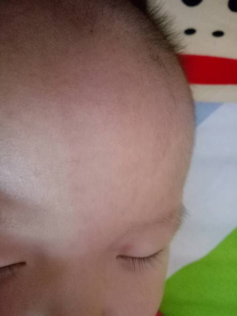 有宝妈碰到过这种情况吗_宝宝额头有红色印记