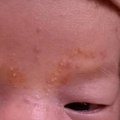 我家宝宝吃母乳,脸上起的是湿疹,还是我吃盐吃的多了