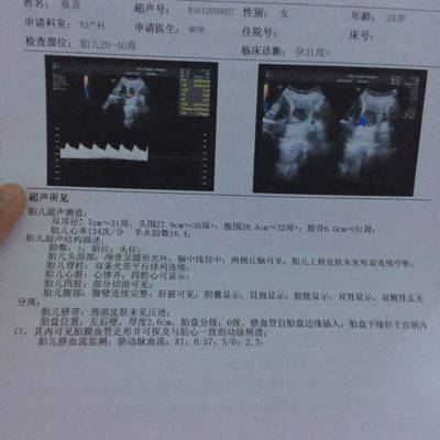 我32周,今天去做bc,医生说我的胎盘低,并且还是球拍状