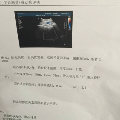 快38周,我的腹围103,宫高38,体重增加了有50斤,胎头低,没有测出双顶径