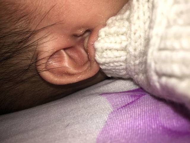 五个月宝宝耳朵流黄水