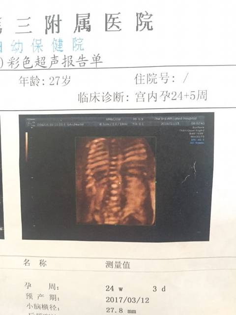 胎儿半椎体畸形