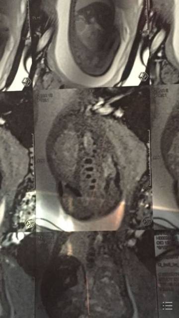 胎儿半椎体畸形_孕25周的时候,做四维彩超查出