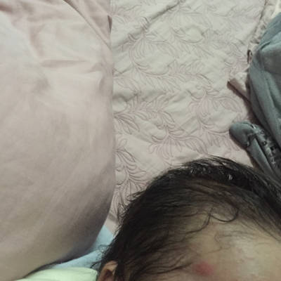 宝宝脸上长了湿疹、昨晚忽然冒出2粒大包跟蚊