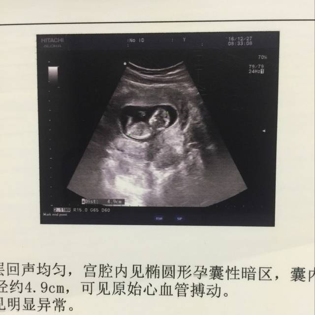 十二周b超看性别_早期B超图看胎儿生殖结节辩