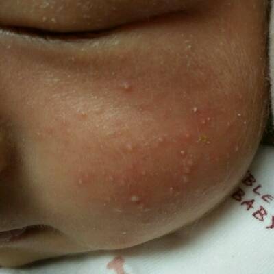 新生儿24天脸上起红色带白头痘痘是怎么回事