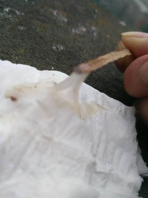 白带,_上个月做了输卵管腹腔镜手术后,前两天