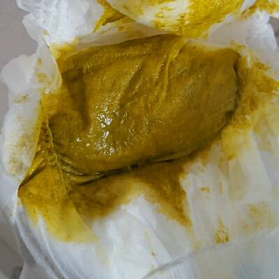 有图慎入:各位宝妈,宝宝快两个月了,拉稀,便便有