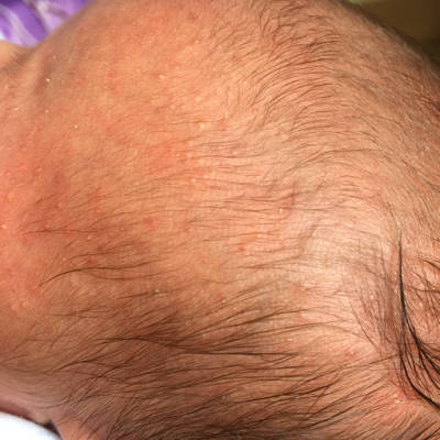 宝出生20天 前一个星期脸上就开始慢慢的长红