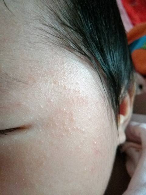 宝宝脸上的疙瘩是湿疹还是痱子?_宝宝脸上的