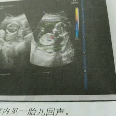 怀孕十七周,其他正常,就是看到胎儿肚子上呈暗