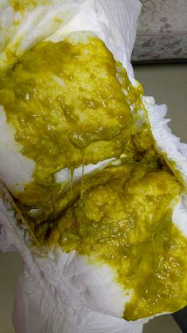 便便有9种颜色,只有3种是健康的(附健康九色卡