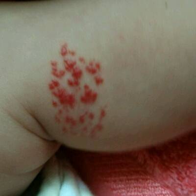 想问问专家小宝宝脚上长的红斑是什么来的!一生下来就