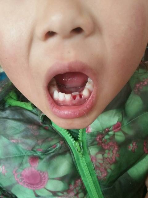 宝宝6岁3个月,该换牙了,最近发现她乳牙滞留,新