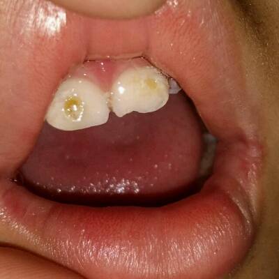 吃甜食和牛奶只吃水果呀怎么还是不能停止牙齿坏呀一直这样可怎么办呀