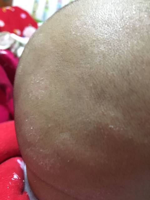 哪位宝妈知道请告知_最近宝宝头上起了这种像