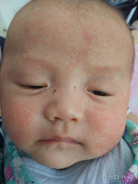 两多月的宝宝_脸上很红起干皮,已经有半个多月