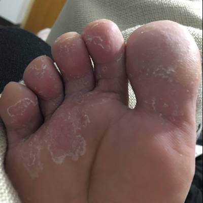 孕后期脚趾头蜕皮,指缝很痒,有什麼好办法止痒吗?