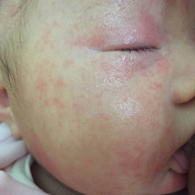 2个月婴儿脸长湿疹怎么办?_2个月婴儿脸长湿