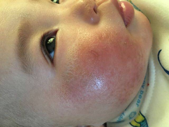 宝宝湿疹怎么治疗_我家宝宝湿疹涂了好多药膏