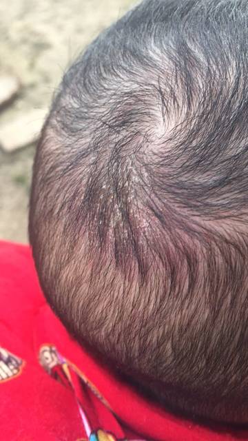 急 急 急 重要的事情说三遍 看看宝宝头上长的是