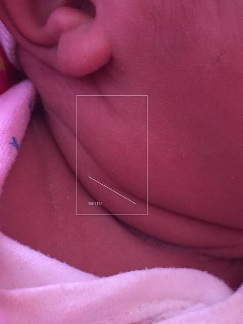 宝宝右边脖子下边长个小疙瘩,急求解释_宝宝今