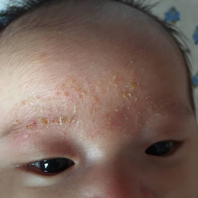 宝宝额头上刚开始是长了像耐藓一样的东西在眉