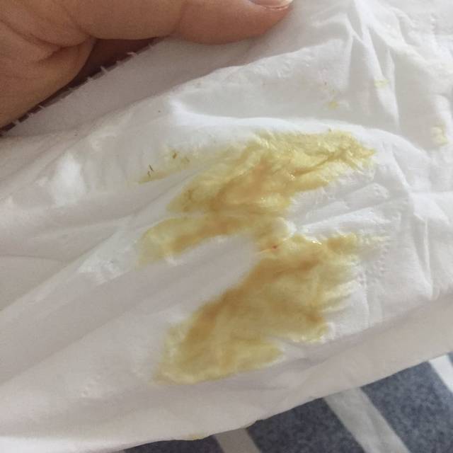 31周白带血褐色白带多 !_怀孕31周了。白带特