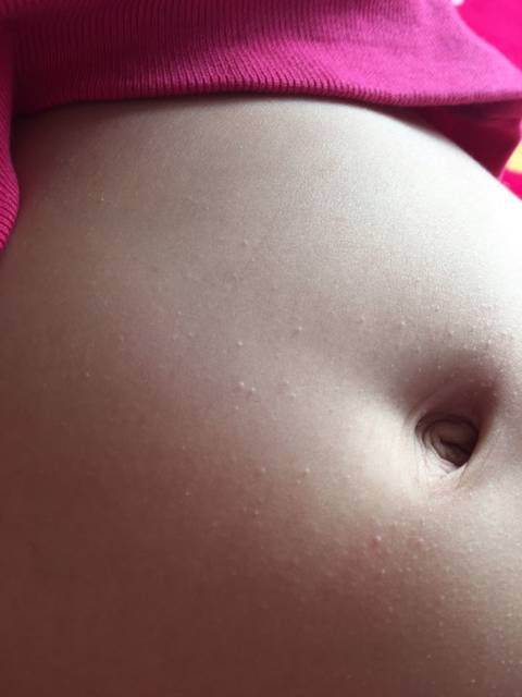 有同龄宝宝得了糙皮病的么?_宝宝肚子上长了很多这种小颗粒.怎_宝宝树