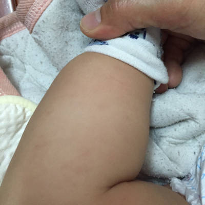 宝宝大哭后,小腿出现了紫色斑点,这是怎么啦,图中是刚