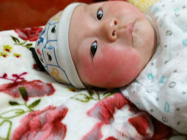 !宝宝四个月了脸上是湿疹还是热疹啊?