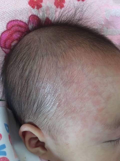 宝宝发烧后出了一身的红疹, !_宝贝打脊灰疫苗