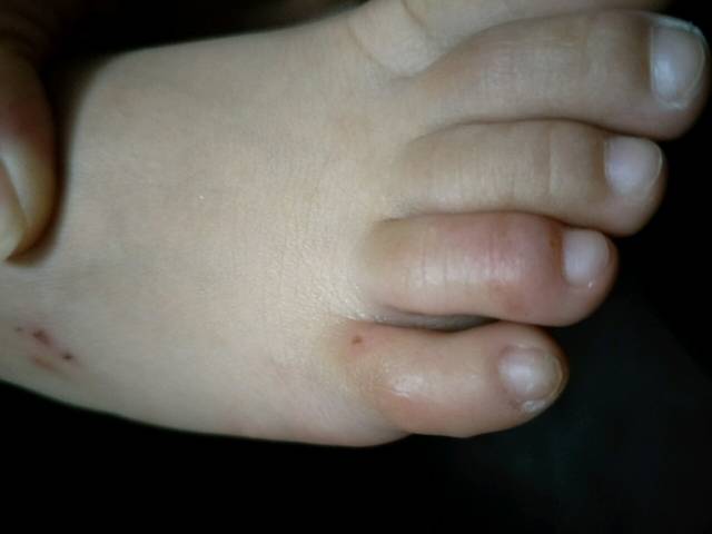 宝宝脚上腿上长了红疹,很痒,还有水泡,有人知道