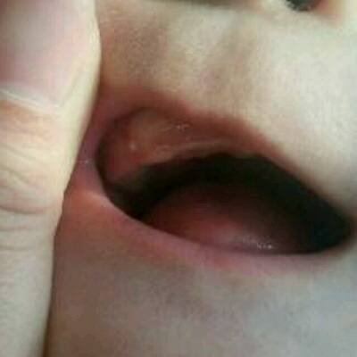 有宝妈知道吗?六个月宝宝 牙龈右下面有白点是怎麼回事.