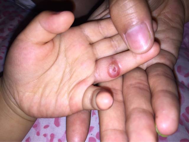 之前女儿手上长了像瘊子一样的,长