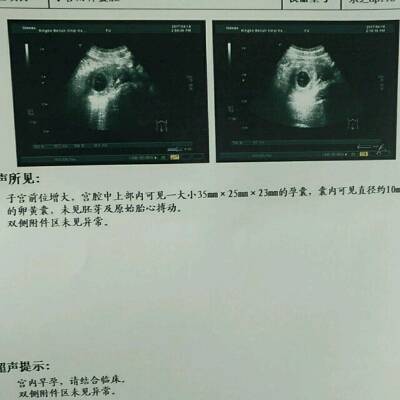 育儿问答 怀孕期 我去做了b超,显示未见胚芽及原始心管搏动