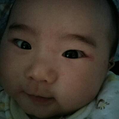 宝宝眼角红了,眼睑上有小红坨子,老是用手揉眼