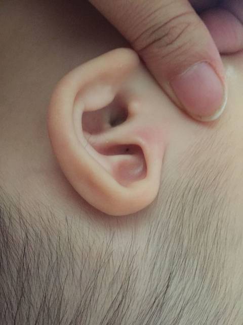 宝宝耳朵上有个黑洞是怎么回事?_宝宝耳朵轮